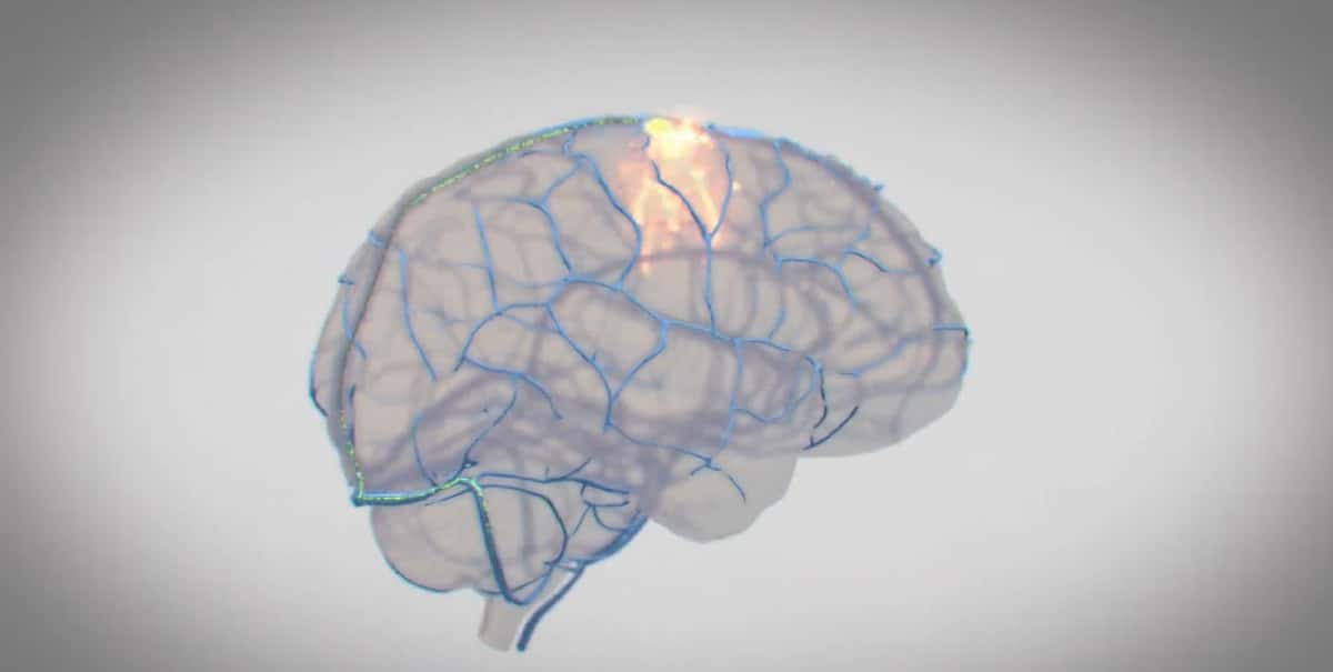 Synchron chce mozgovým implantátom liečiť Parkinsona